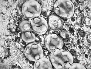 F, 45y. | necrobiosis lipoidica F, 45y. | necrobiosis lipoidica